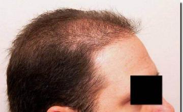 Hair restoration procedure results