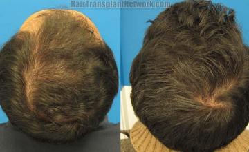 Hair restoration procedure before and after pictures