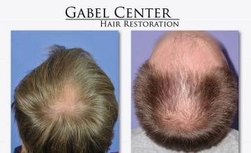 Hair transplant surgery before and after images