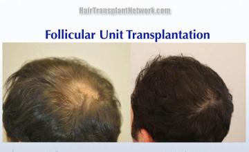  Before and after hair transplant surgery result images