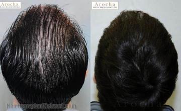 Hair restoration procedure before and after pictures