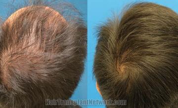 Hair transplantation surgery before and after pictures