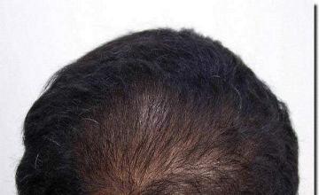 Hair restoration procedure results