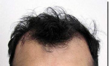 Hair restoration procedure results