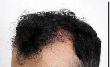 Hair restoration procedure results