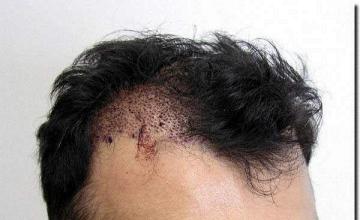 Hair restoration procedure results