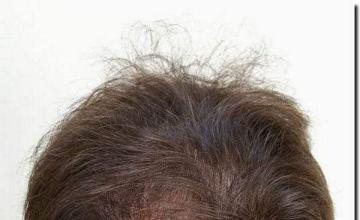 Hair restoration procedure results