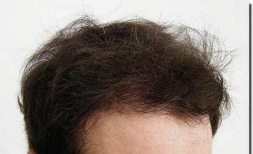 Hair restoration procedure results