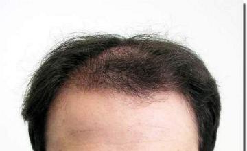 Hair restoration procedure results