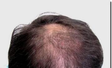 Hair restoration procedure results