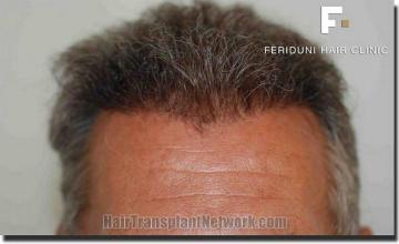 Hair restoration procedure results