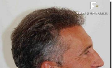 Hair restoration procedure results