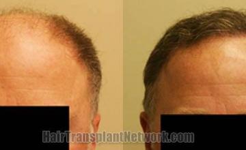 Hair restoration procedure before and after results