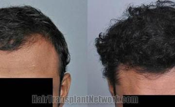 Front view - Before and after