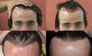 Hair restoration procedure before and after results