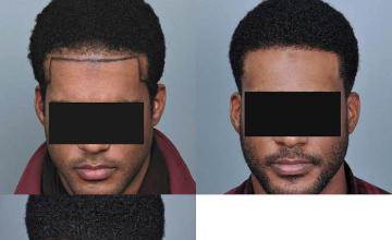 Hair restoration procedure before and after results