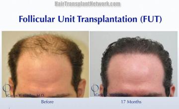 Hair restoration procedure before and after results