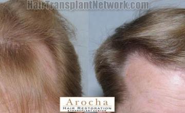 Hair restoration procedure before and after results