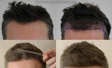 Hair restoration procedure before and after results