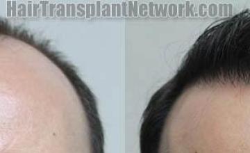 Hair restoration procedure before and after results