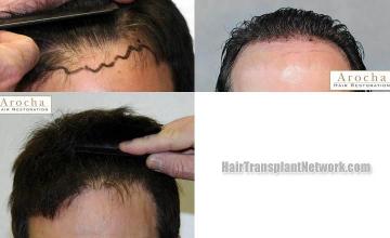 Hair restoration procedure before and after results