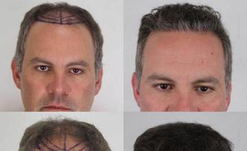 Hair restoration procedure before and after results