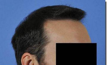 Hair restoration procedure results