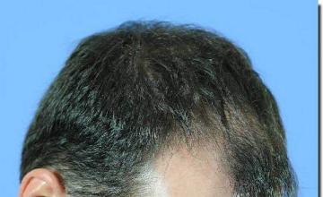 Hair restoration procedure results