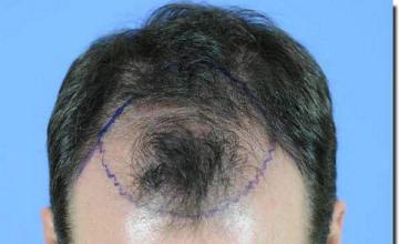 Hair restoration procedure results