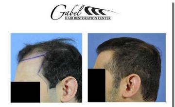 Hair restoration procedure results