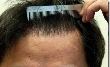 Hair restoration procedure results