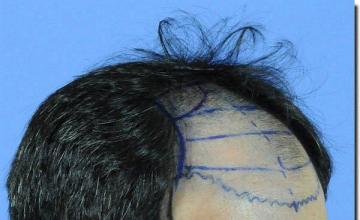 Hair restoration procedure results