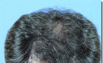 Hair restoration procedure results