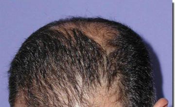 Hair restoration procedure results