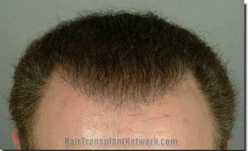 Hair restoration procedure results