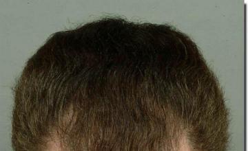 Hair restoration procedure results