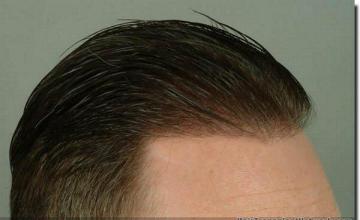 Hair restoration procedure results