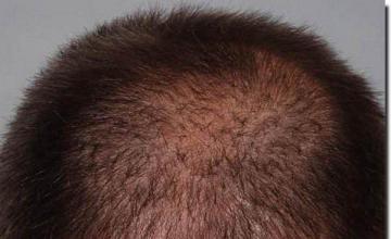 Hair restoration procedure results