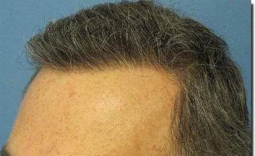 Hair restoration procedure results