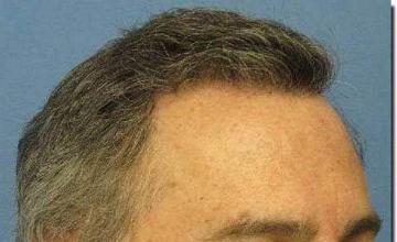 Hair restoration procedure results