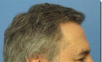 Hair restoration procedure results