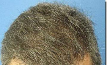 Hair restoration procedure results