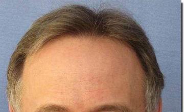 Hair restoration procedure results