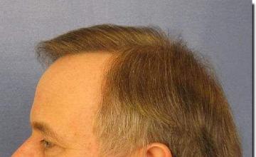 Hair restoration procedure results