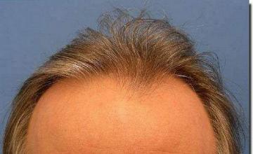 Hair restoration procedure results