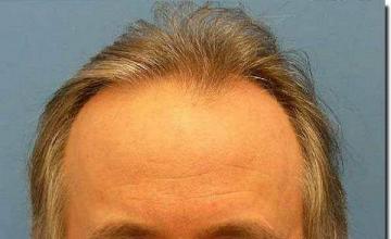 Hair restoration procedure results