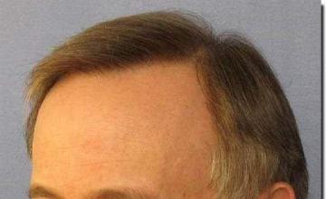 Hair restoration procedure results