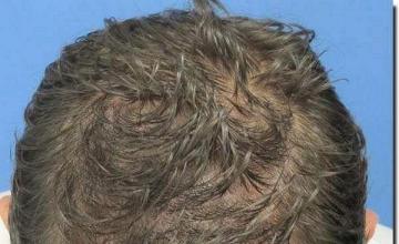 Hair restoration procedure results