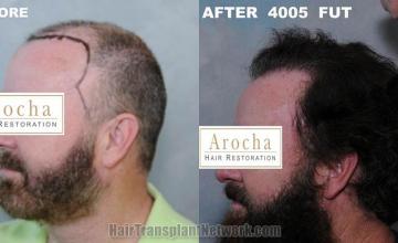 Hair transplantation surgery before and after pictures