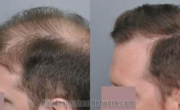 Hair restoration procedure before and after pictures